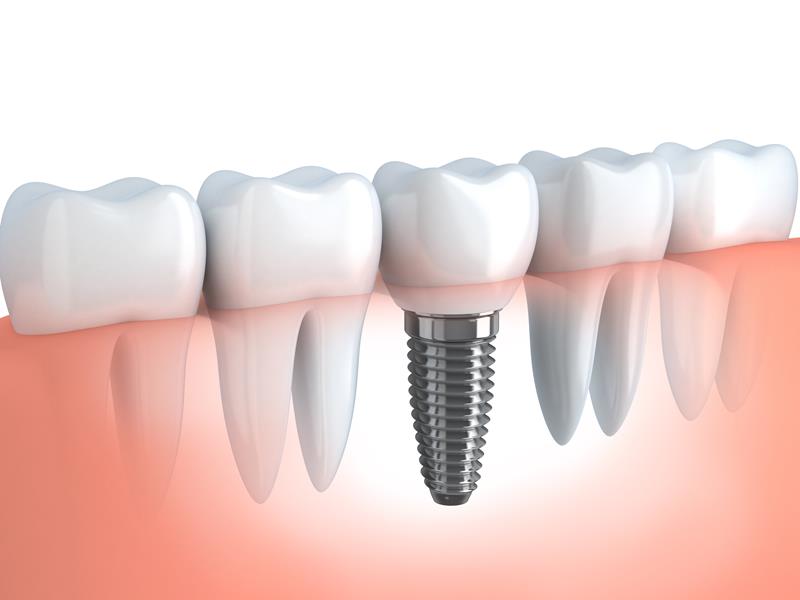 Dental Implants Glen Carbon, IL 