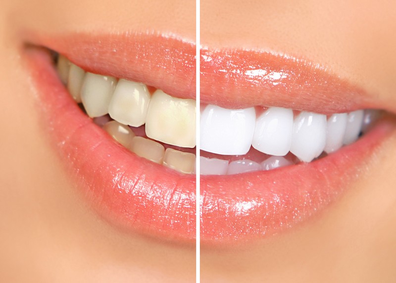 Teeth Whitening Glen Carbon, IL 